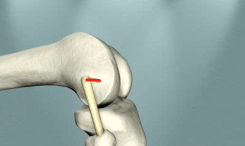 Animation of Normal Knee