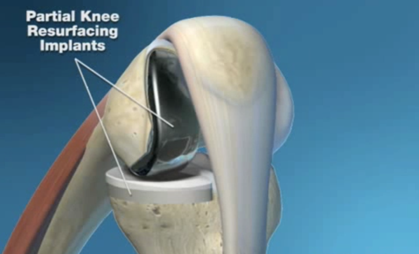Animation of Triathlon® Partial Knee Resurfacing