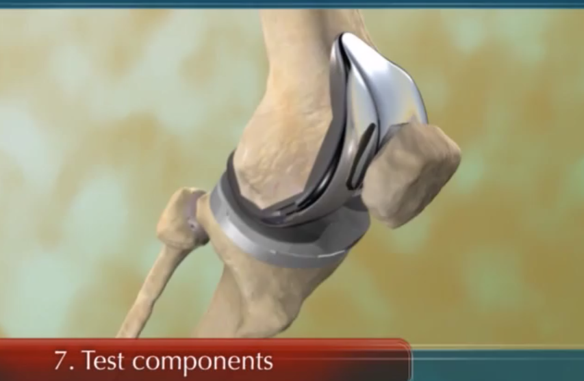 The Surgical Procedure for Total Knee Replacement