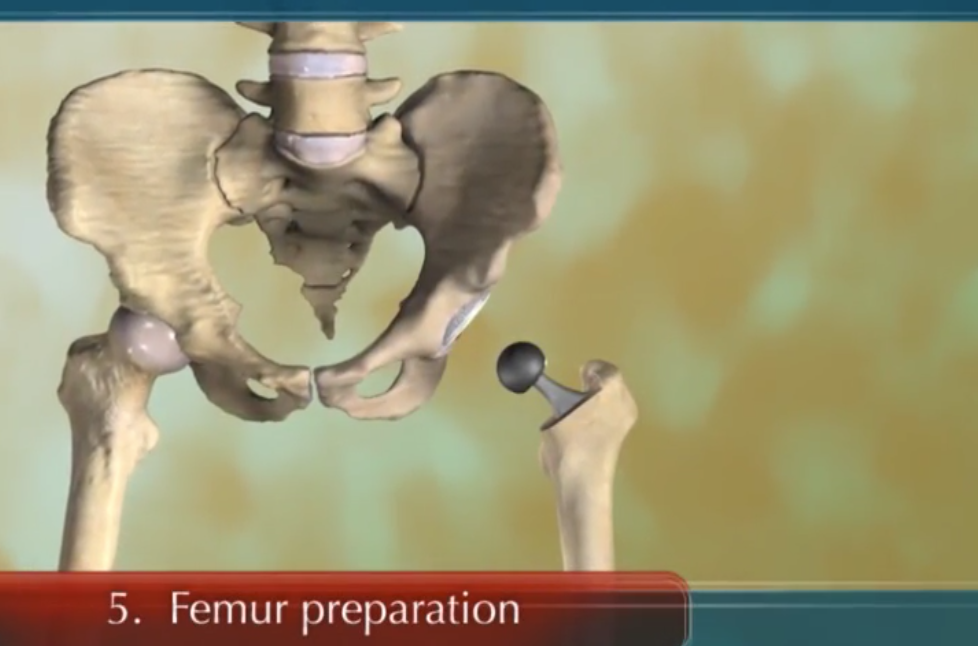 The Surgical Procedure for Total Hip Replacement