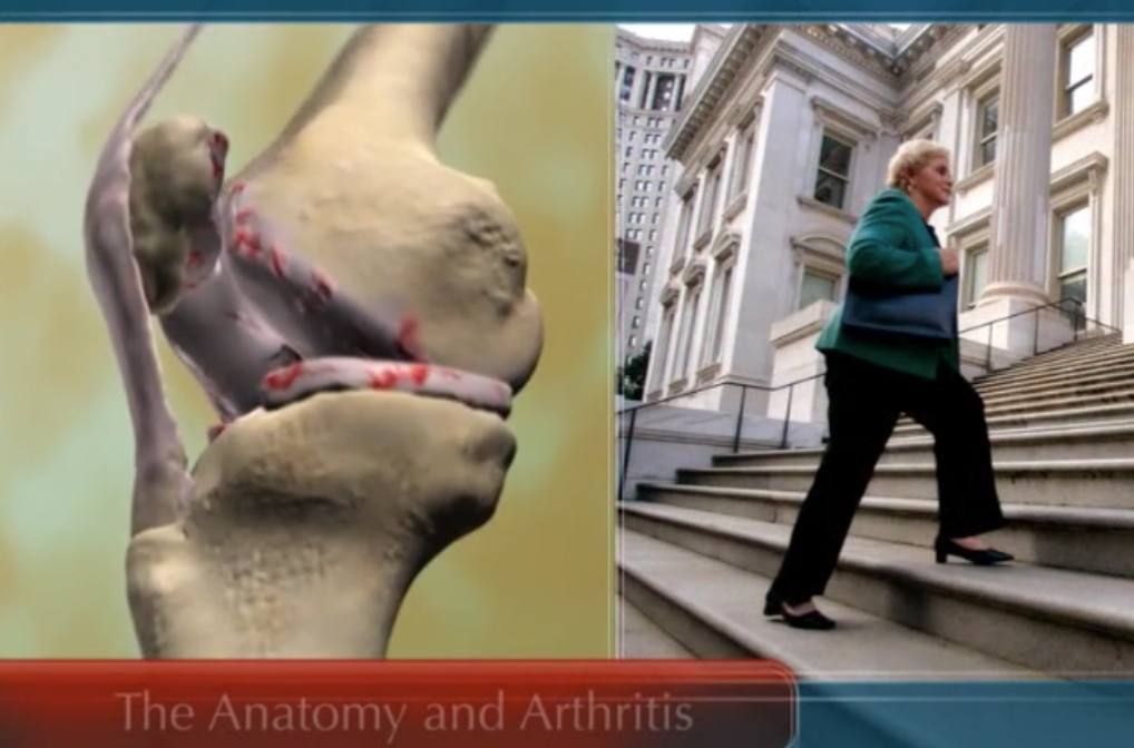 The Anatomy and Arthritis - Knee