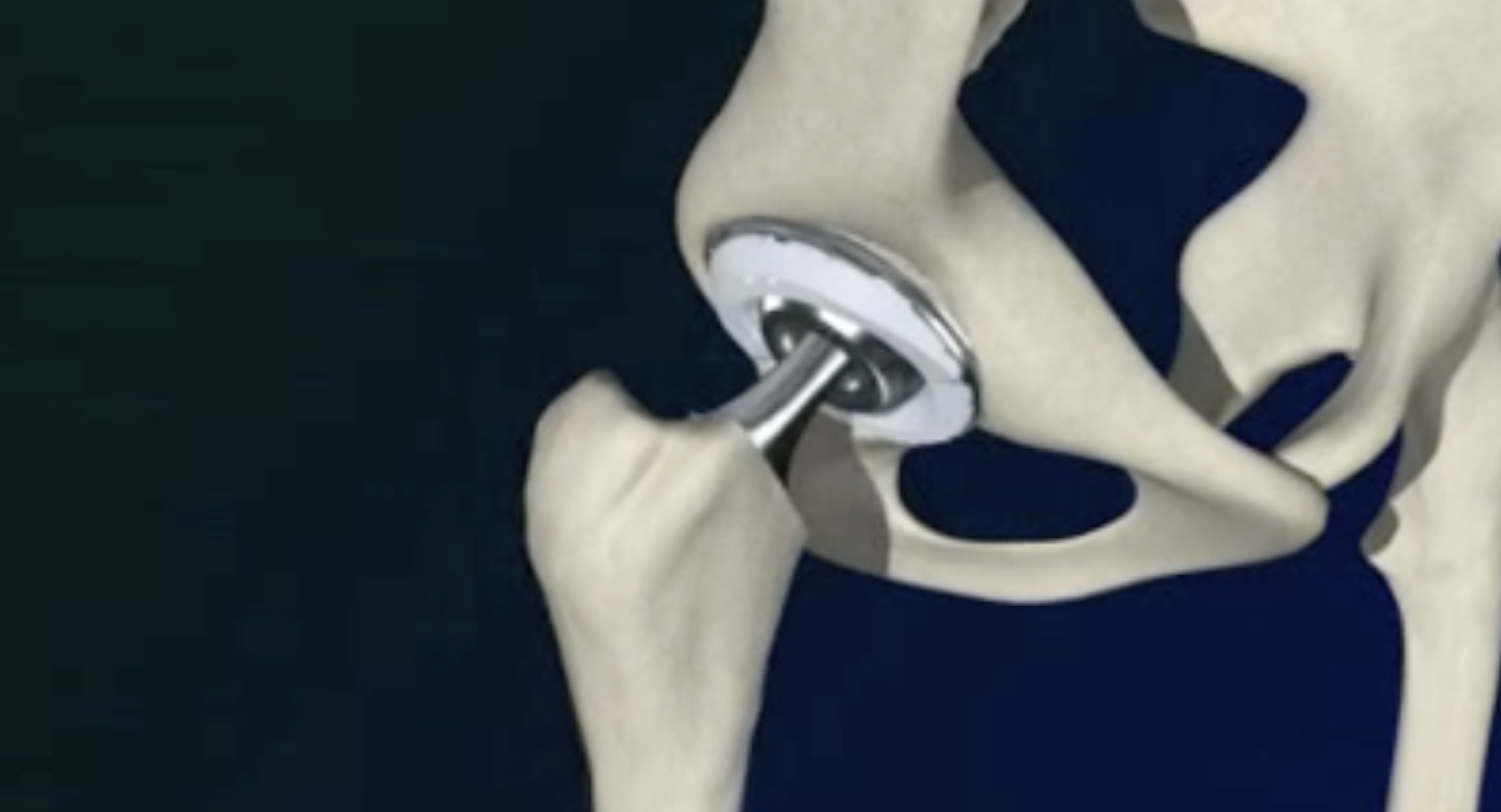 Animation of Total Hip Replacement