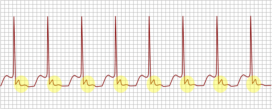 Picture of heart beat graph