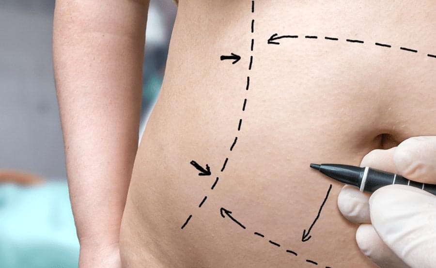 Picture of doctor drawing lines on stomach for a Tummy Tuck procedure