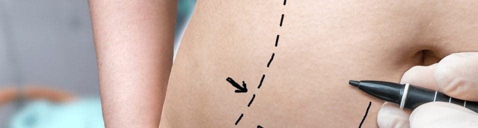 Picture of doctor drawing lines on stomach for a Tummy Tuck procedure