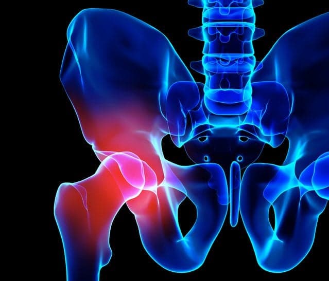 Picture of 3D illustration, hip painful skeleton x-ray, medical concept.