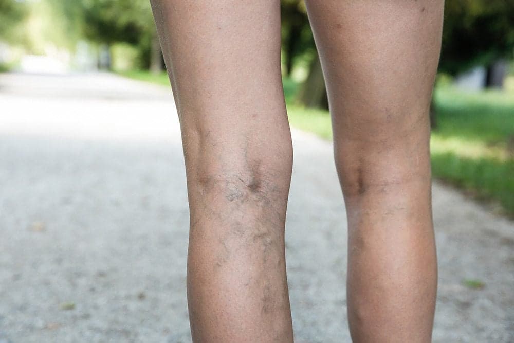 Picture of spider veins