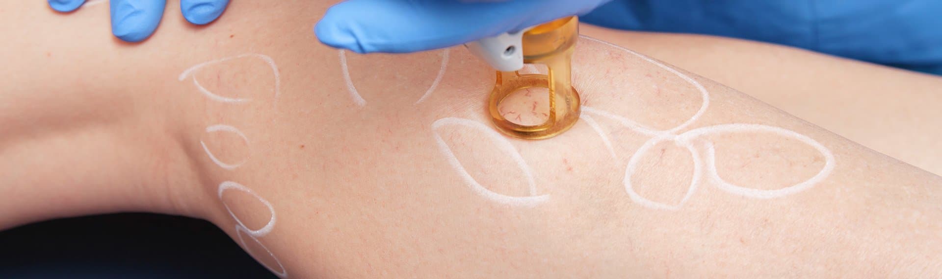 Picture of vascular veins treatment