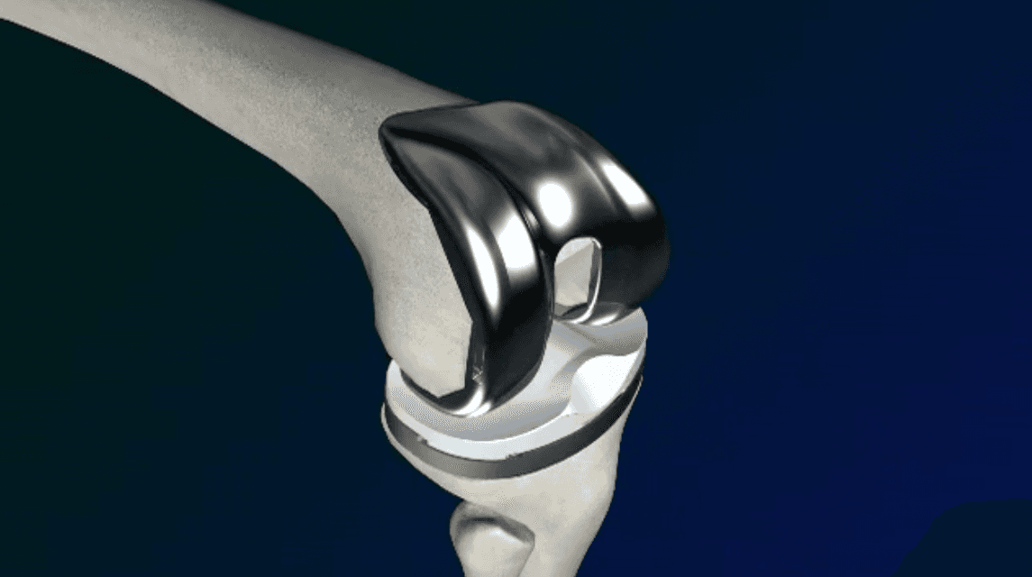 Animation of Total Knee Replacement