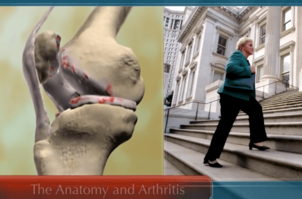 The Anatomy and Arthritis - Knee