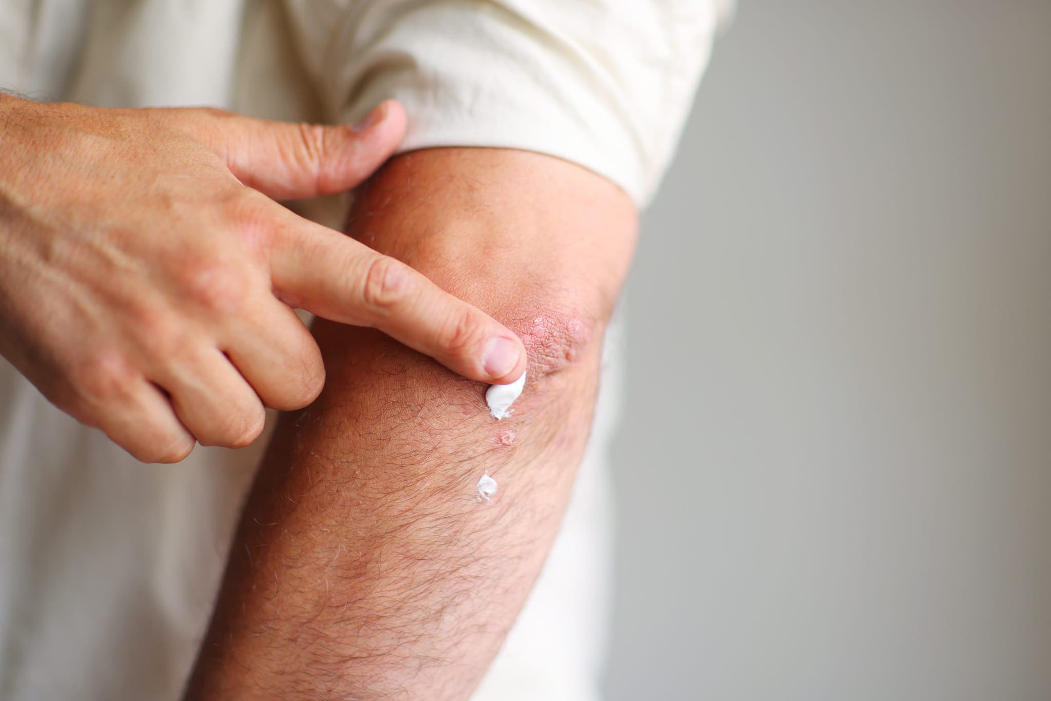 Picture of applying an cream emollient to dry flaky skin as in the treatment of psoriasis, eczema and other dry skin conditions