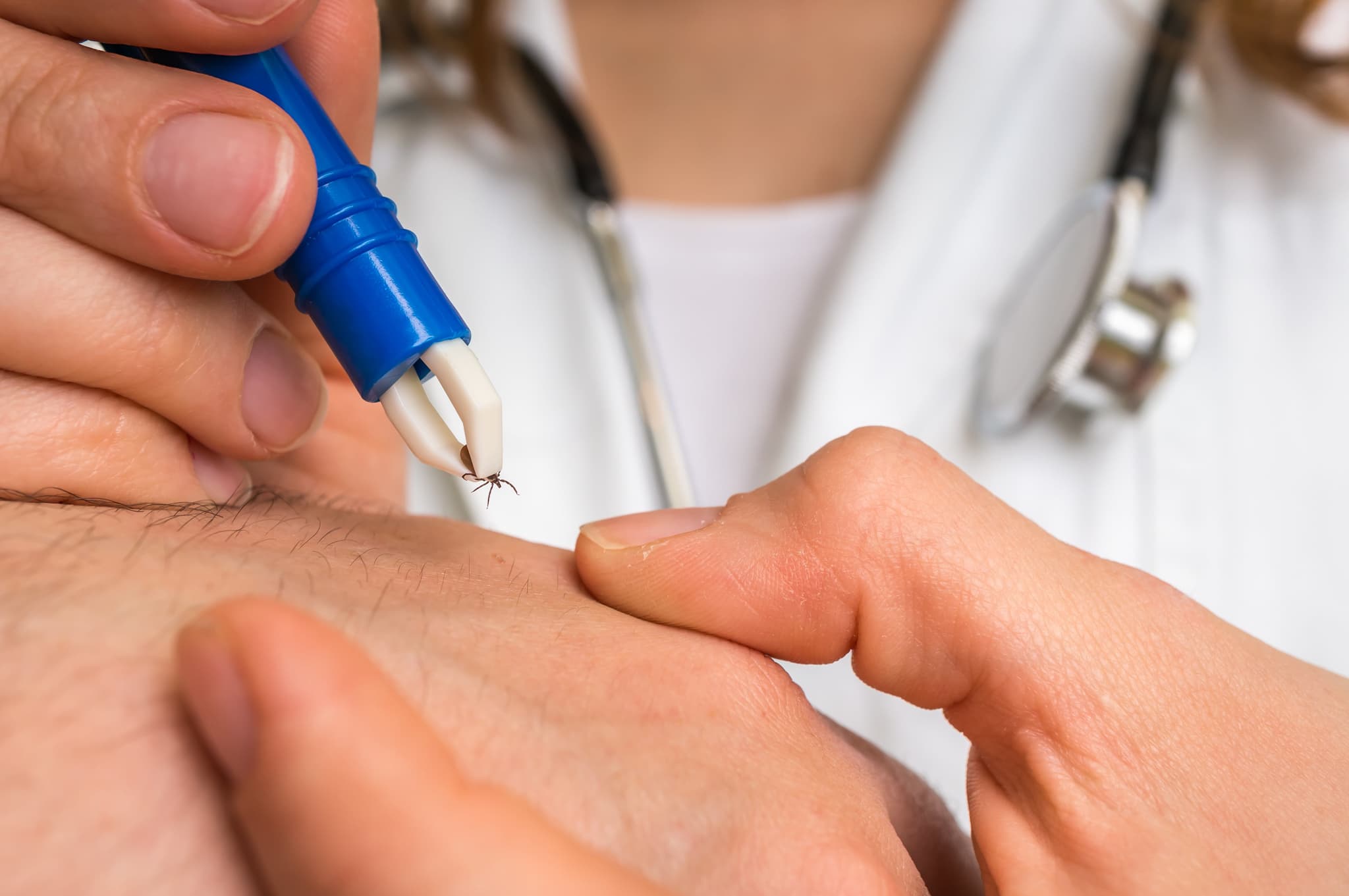 Picture of Female doctor removing a tick with tweezers from hand of patient. Encephalitis, borreliosis and lyme disease.