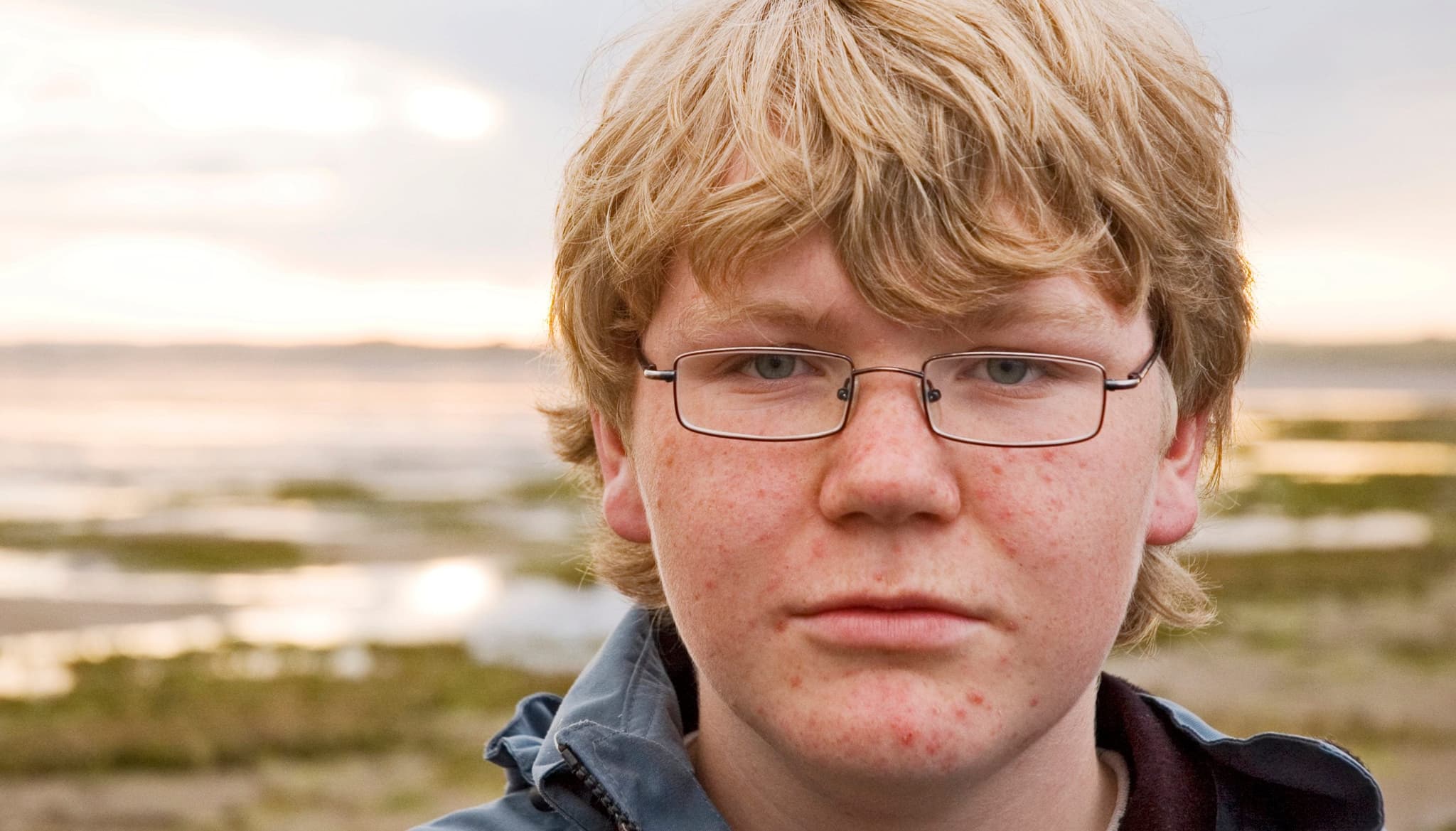 Picture of man with acne and classes looking into camera