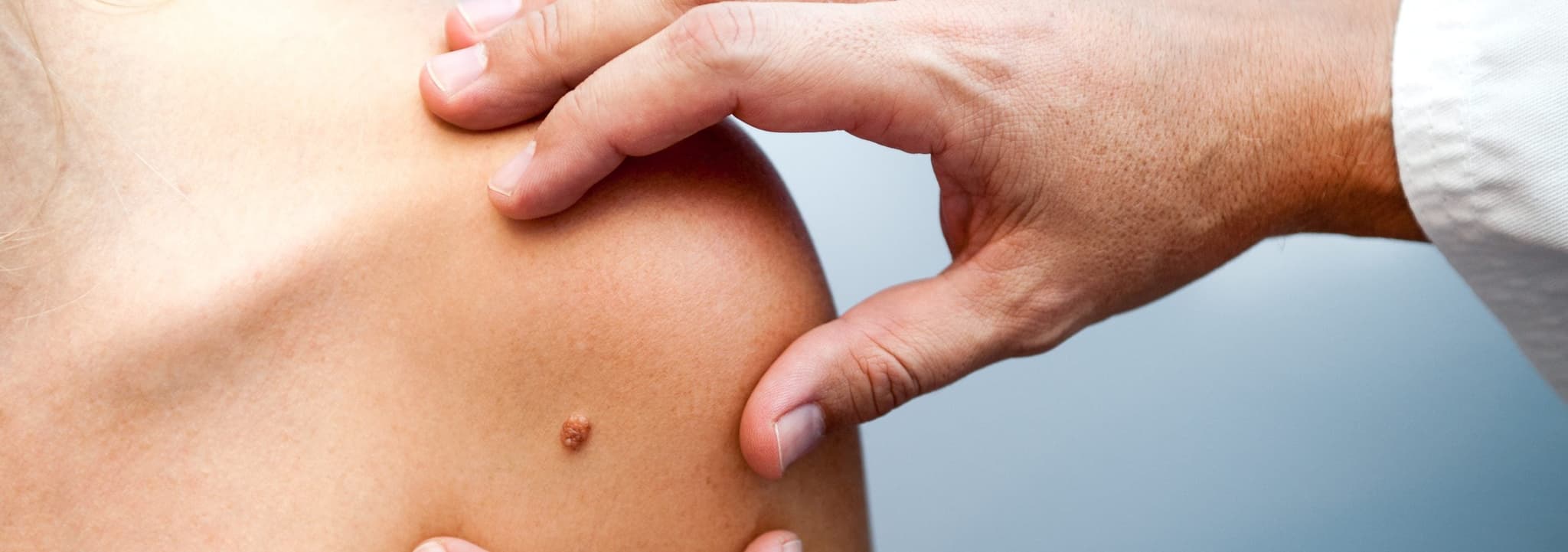 Picture of person with mole being examined by a doctor