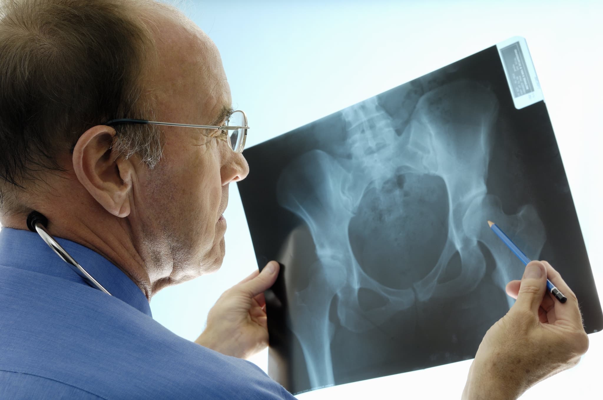 Orthopaedic surgeon consulting pelvic x-rays for a hip replacement.