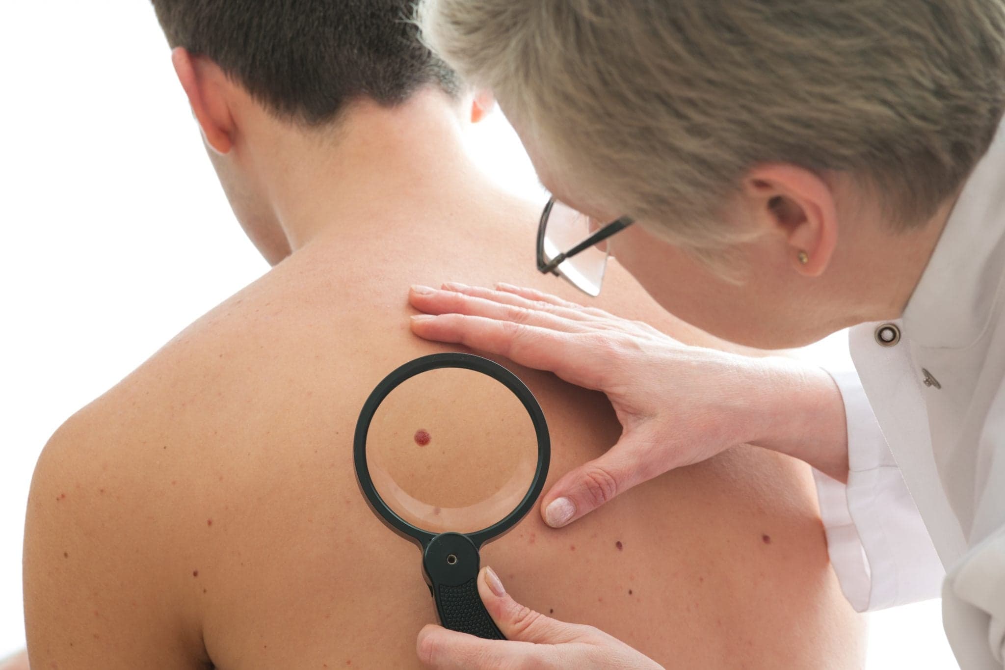 Picture of Dermatologist examines a mole - Dermatologist Provo Utah