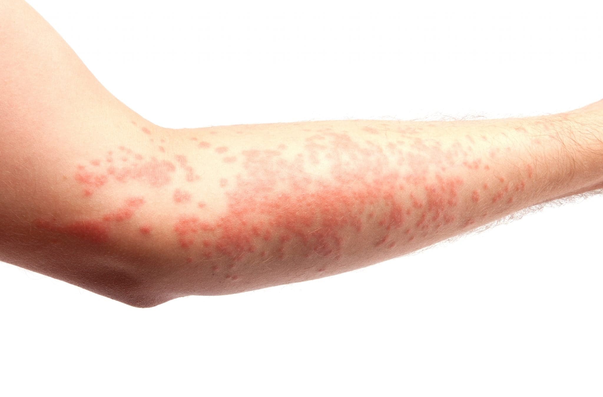 Picture of arm covered in a skin allergy/hives