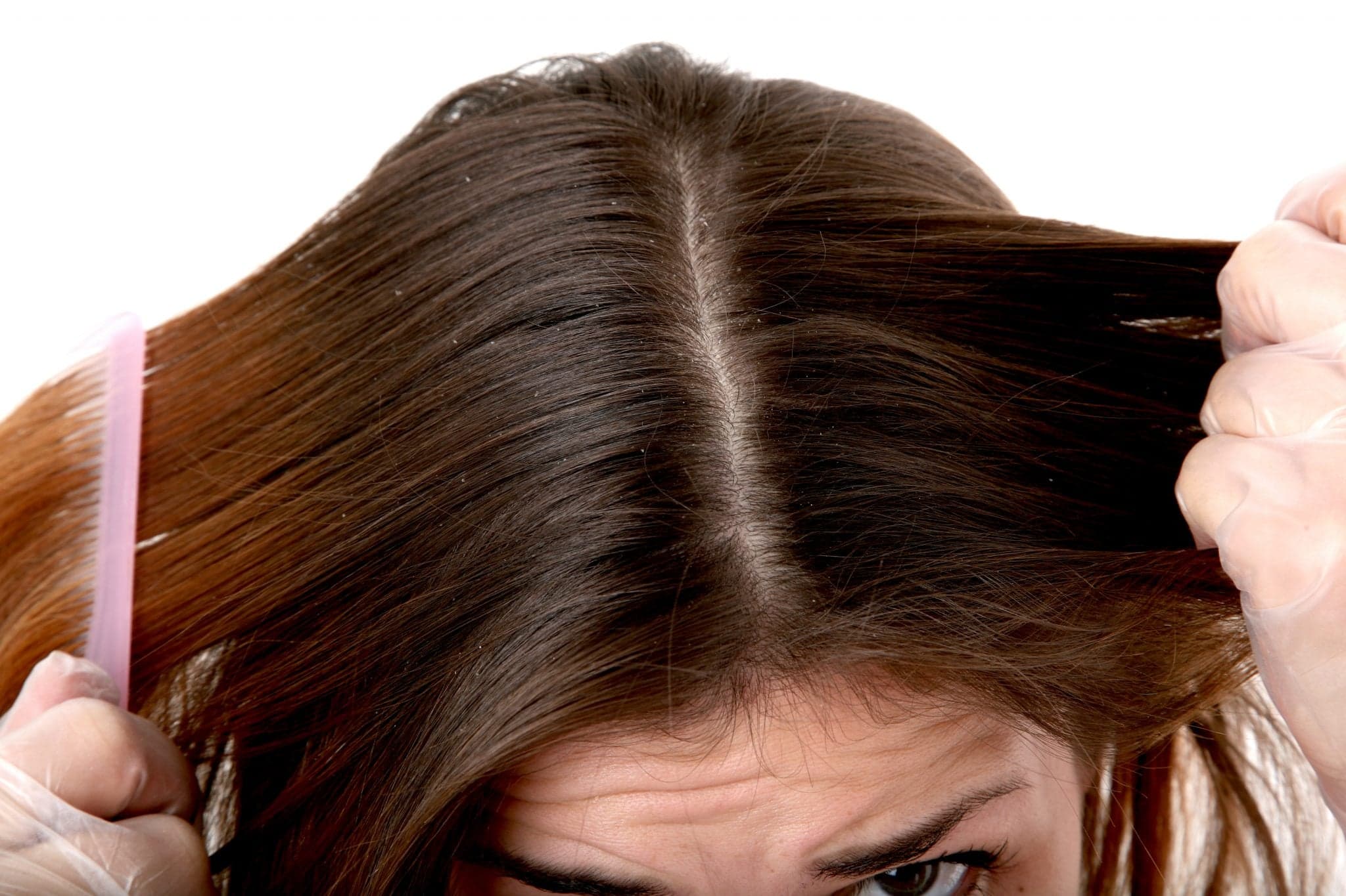 Picture of Picture of a woman combing her hair. At 100% you can see the dandruff in the hair.