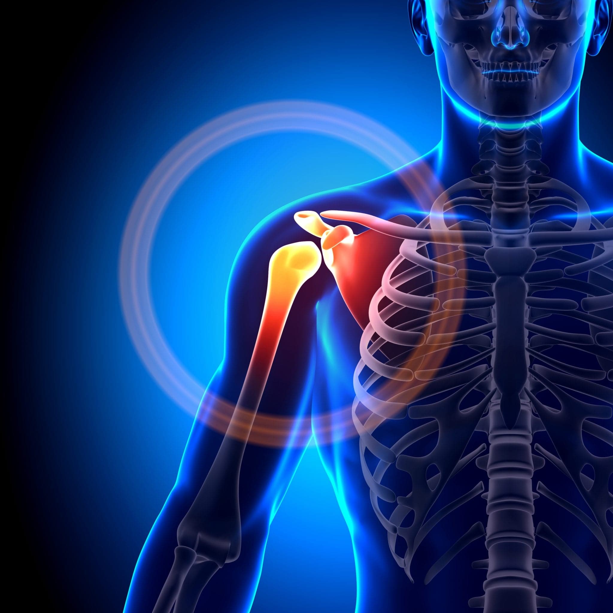 Animated image of a fractured shoulder scapula clavicle