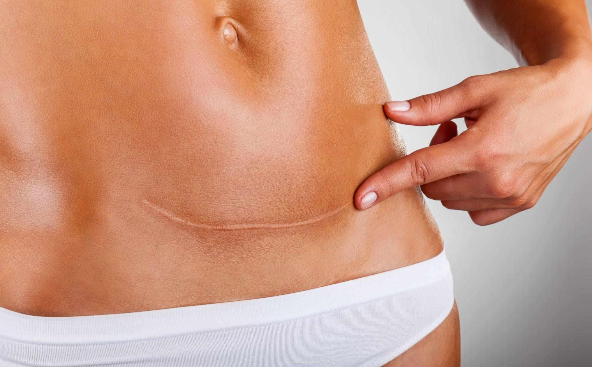 Picture of Closeup of woman belly with a scar from a cesarean section