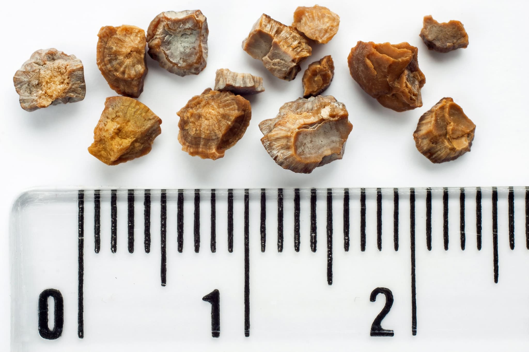 Picture of Kidney stones after ESWL intervention. Lithotripsy. Scale in centimeters