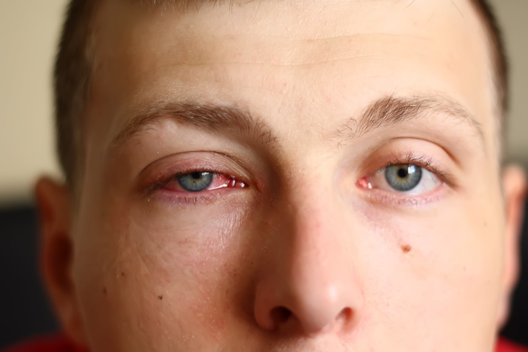 A close-up image of a young male face with a pink eye (conjunctivitis).