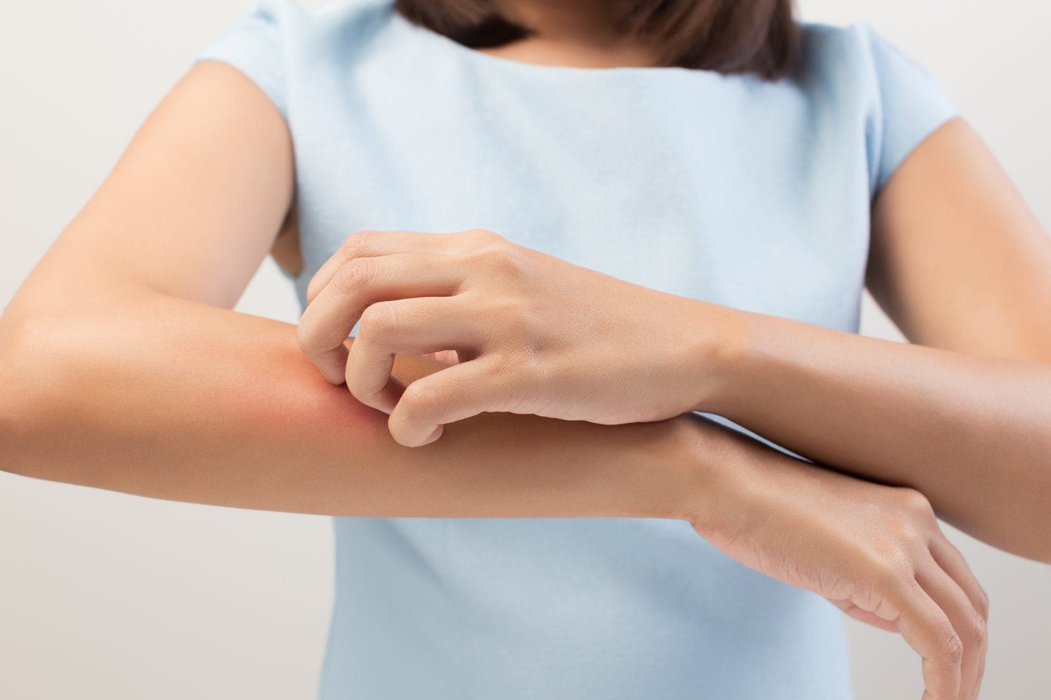 Picture of woman itching her arm