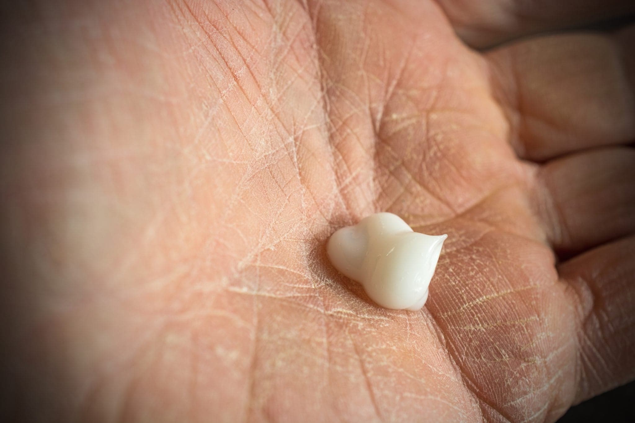 The palm of a rough and worn human hand showing dry skin and hand lotion ready to apply.