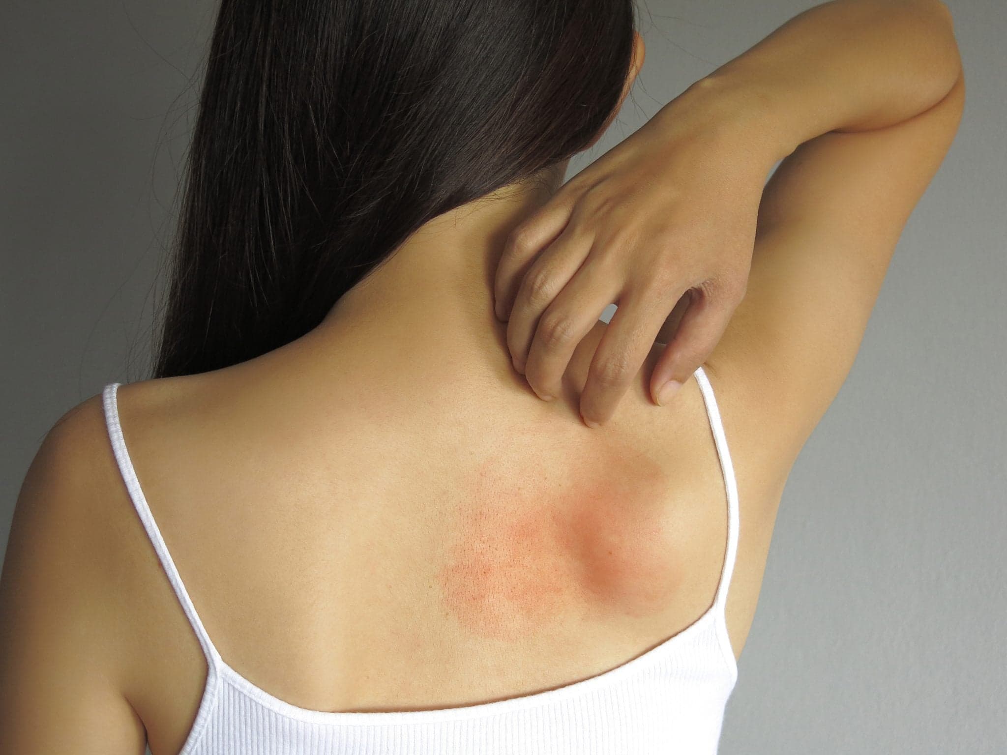 Picture of Health problem. Closeup young woman scratching her itchy back with allergy rash