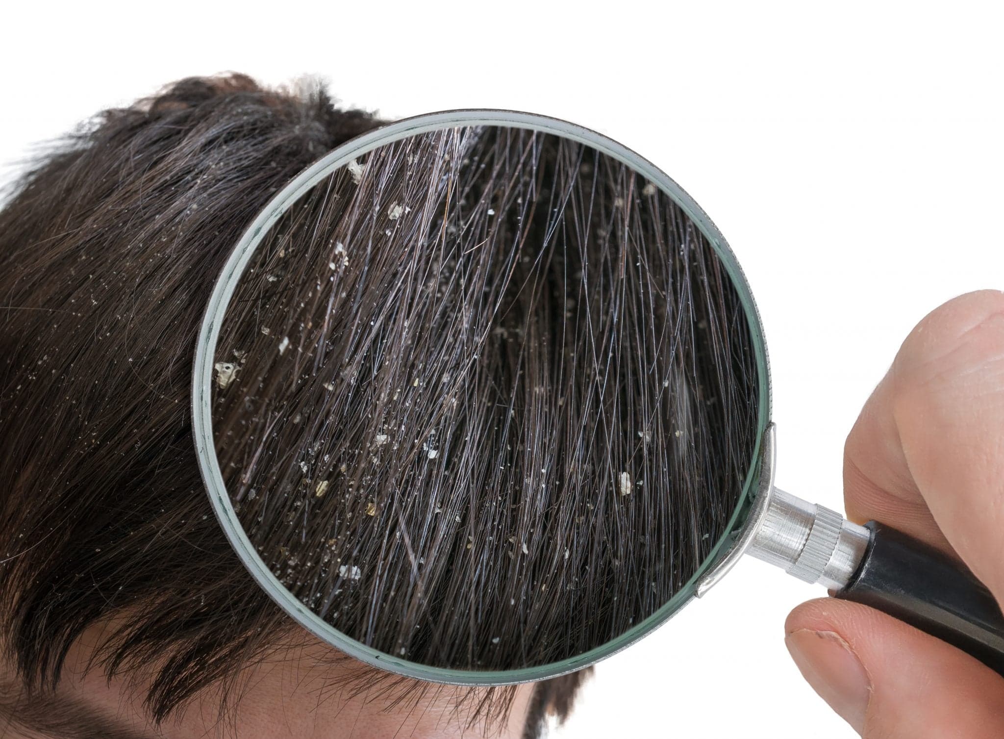 Examining white dandruff flakes in hair with magnifying glass.