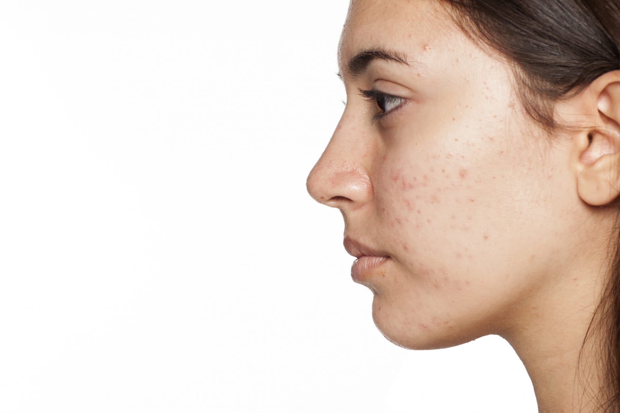 Picture of profile of young girl with acne on white background