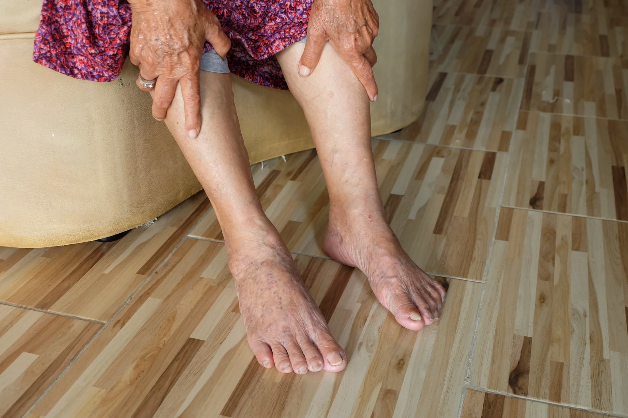 Asian old woman holding a leg that pain from varicose veins on the legs and feet