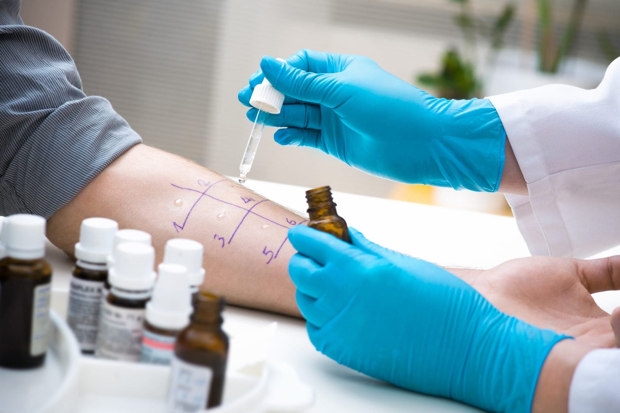 Image of Skin prick test to find out kinds of allergy