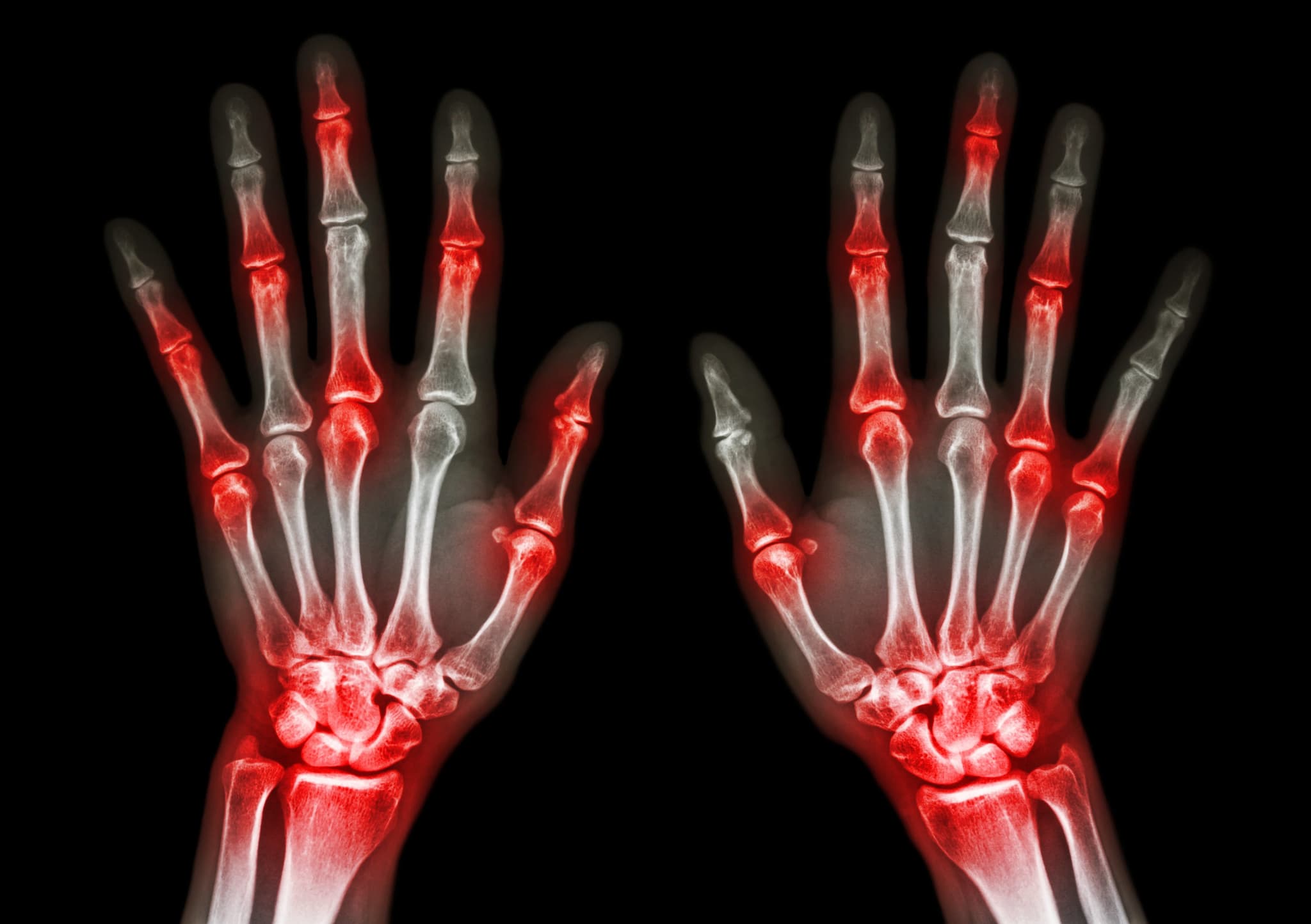 film x-ray both human's hands and arthritis at multiple joint (Gout,Rheumatoid)
