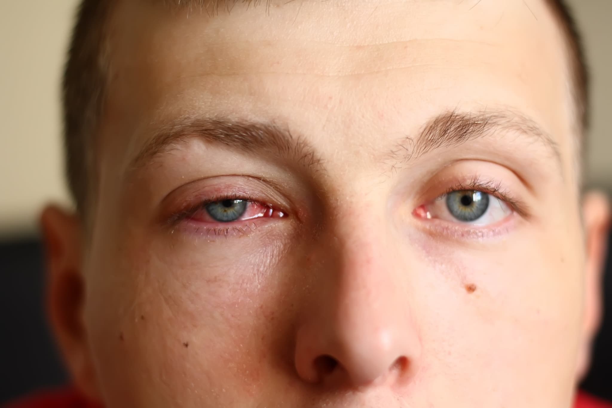 Picture of A close-up image of a young male face with a pink eye (conjunctivitis).