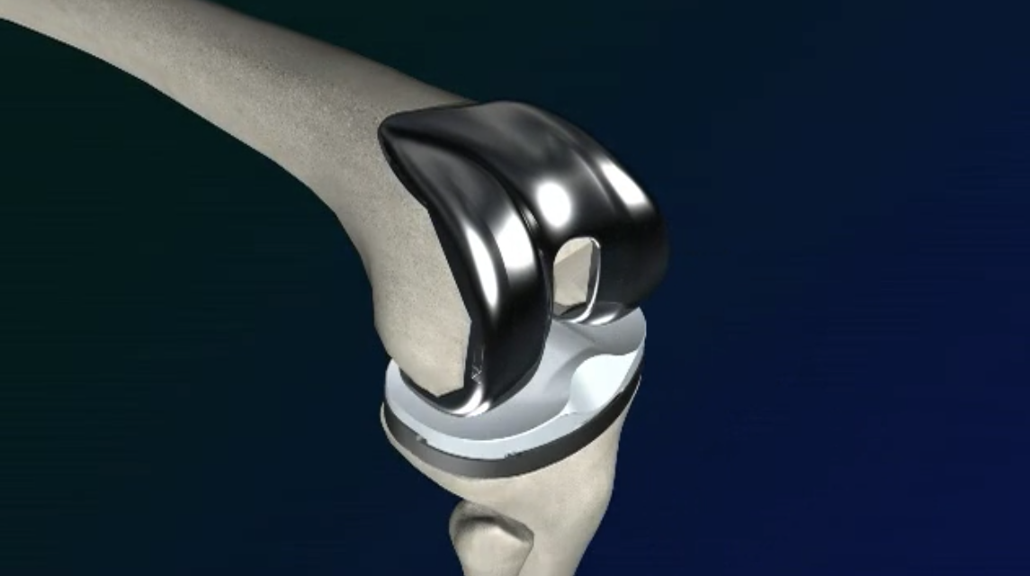 Animation of Total Knee Replacement