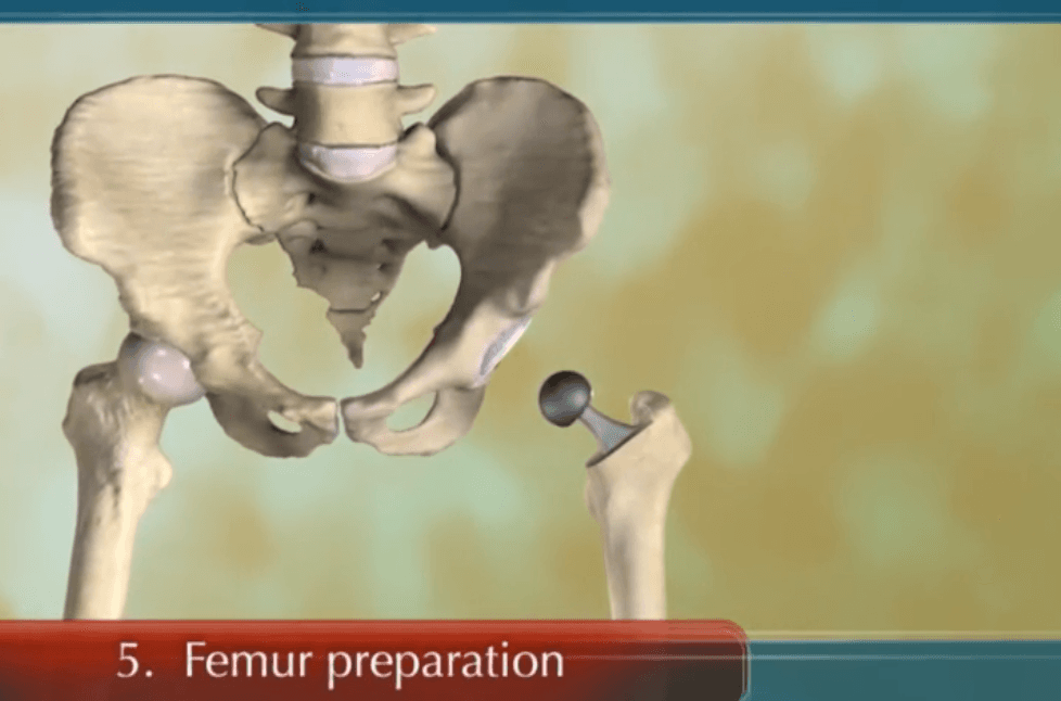 The Surgical Procedure for Total Hip Replacement