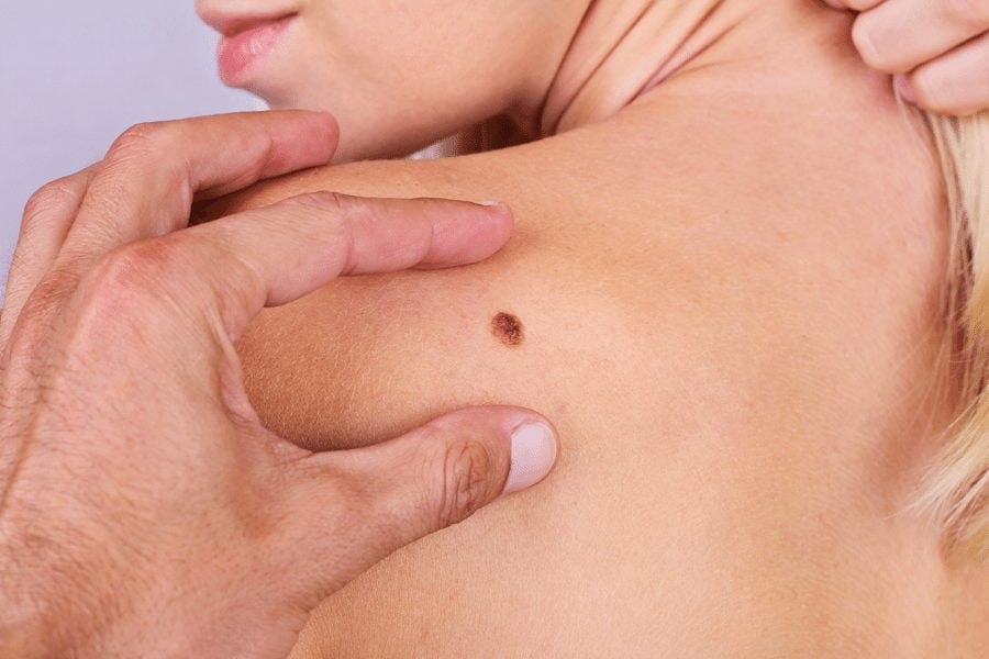 Everything You Should Know About Skin Cancer