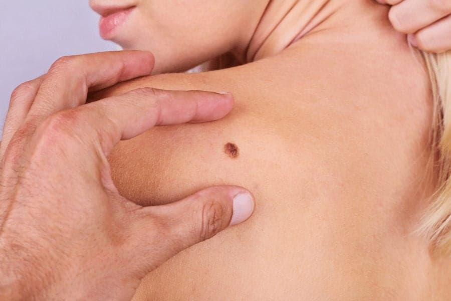woman with mole on shoulder being examined